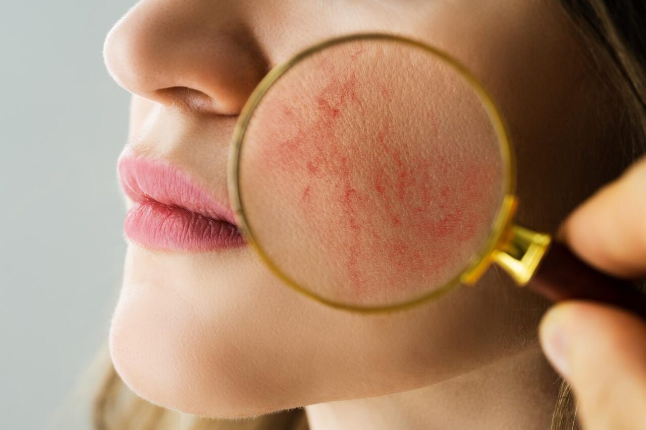 rosacea-grau-1