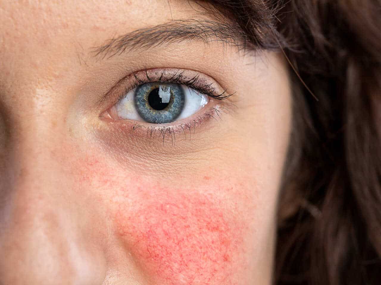 rosacea-fotos