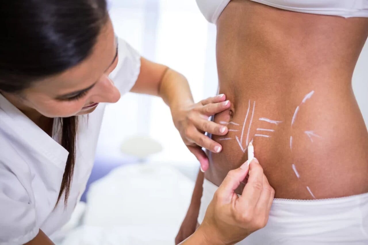 lipo-enzimática-antes-e-depois-1-sessao