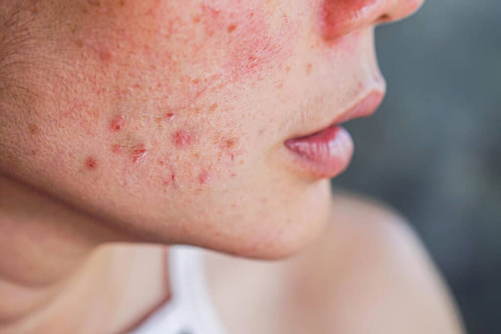 o-que-e-rosacea