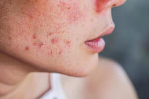 o-que-e-rosacea