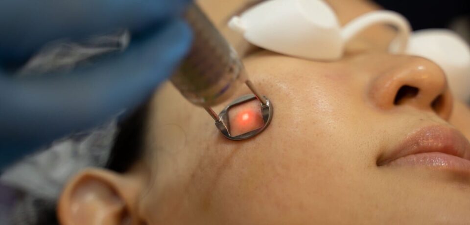 tratamento de melasma