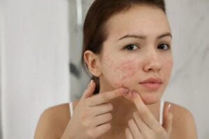 qual o melhor tratamento para acne