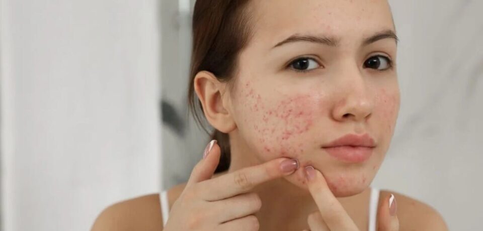 qual-o-melhor-tratamento-para-acne qual o melhor tratamento para acne