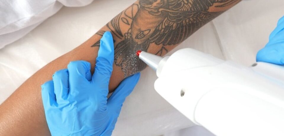 Pessoa removendo tatuagem com profissional